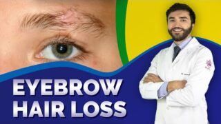 How To Treat Eyebrow Hair Loss