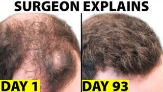 Oral Minoxidil – A Better Hair Loss Treatment?