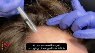 Revolutionizing Hair Loss Treatment Discover Exosome Therapy for Thicker, Healthier Hair