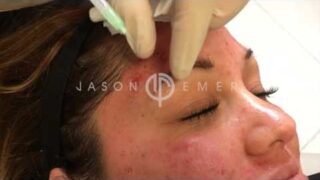 THICKEN YOUR EYEBROWS AND STOP THINNING WITH PRP AND HORMONES FOR HAIR RESTORATION | DR. JASON EMER